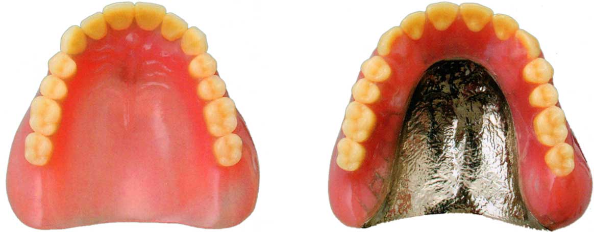 保険診療による厚みのあるプラスチック性の入れ歯（左）と自由診療による金属を用いた割れにくく薄い入れ歯（右）