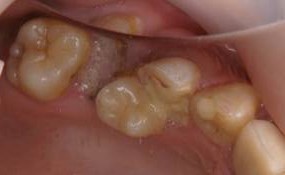 1本だけ内側にある歯をMTMで移動した症例治療前
