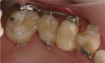 1本だけ内側にある歯をMTMで移動した症例治療後
