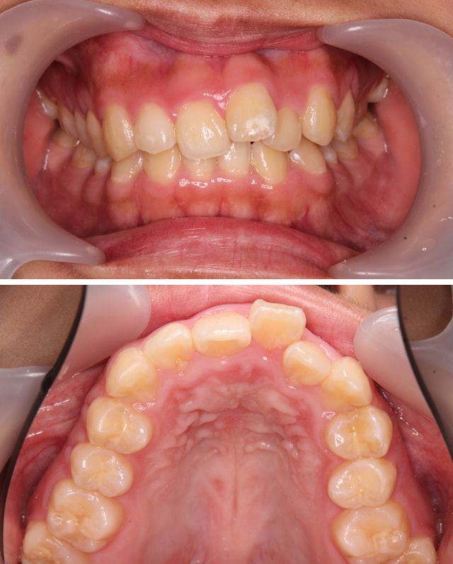 ＭＴＭで上の前歯の歯並びを治療した症例1治療前
