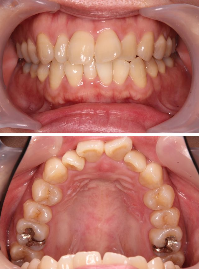 ＭＴＭで上の前歯の歯並びを治療した症例2治療前