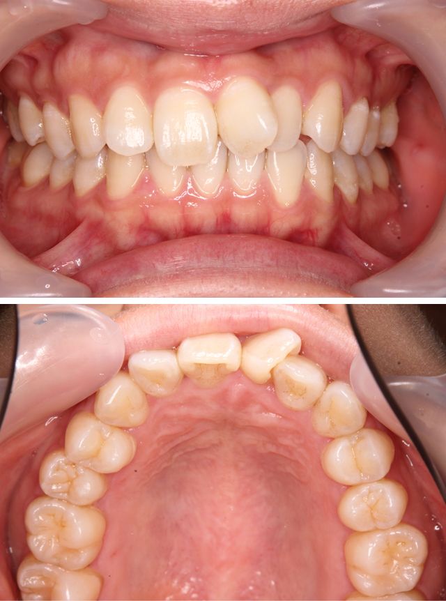 ＭＴＭで上の前歯の歯並びを治療した症例4治療前
