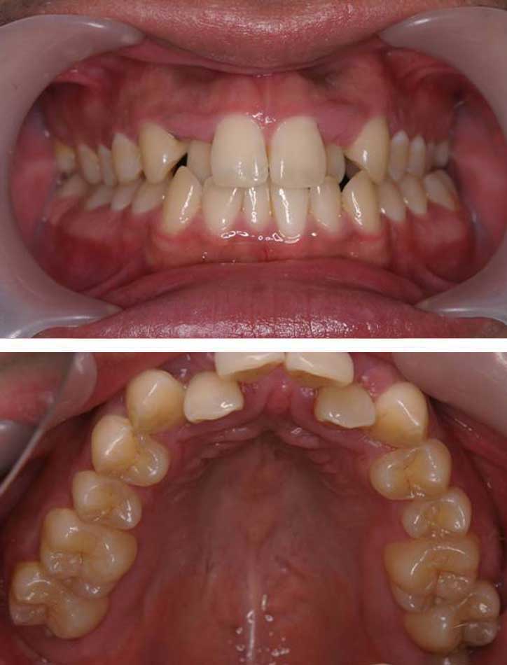 MTMで上顎前歯の歯並びを治療した症例2治療前