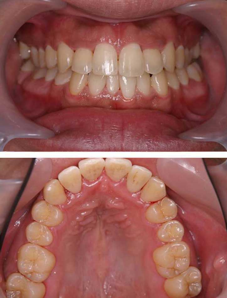 MTMで上顎前歯の歯並びを治療した症例2治療後