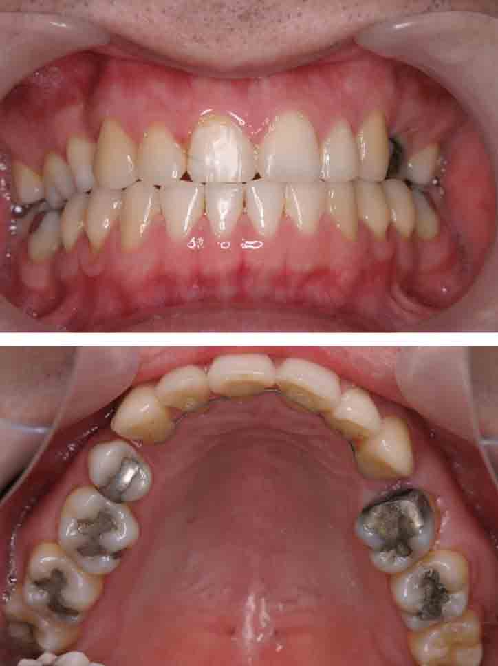 MTMで上顎前歯の歯並びを治療した症例治療後
