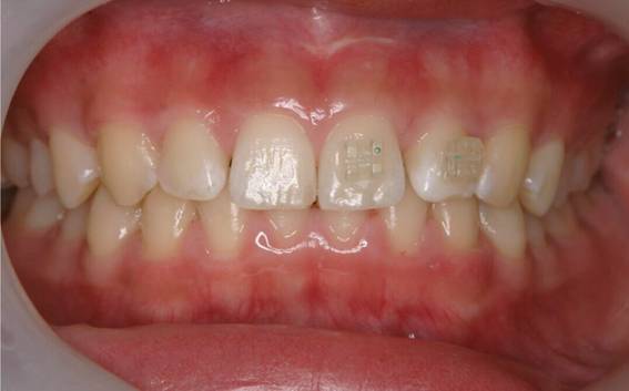 前歯の隙間をMTM（部分矯正）で治療した症例治療前