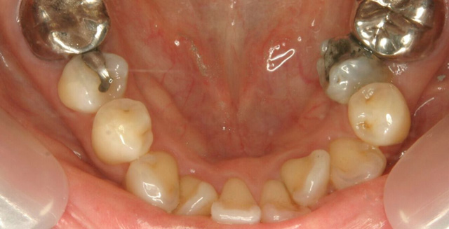 MTMで下顎前歯の歯並びを治療した症例１治療前
