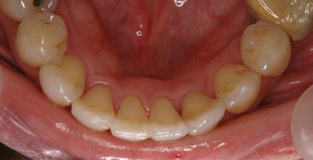mtm-顎前歯1-治療後