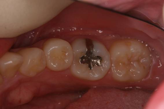 下の奥歯の金属を、コンポジットレジンで修復し直した症例治療前