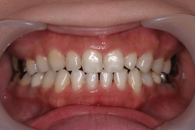 下の前歯3本をラミネートベニアで修復した症例治療前