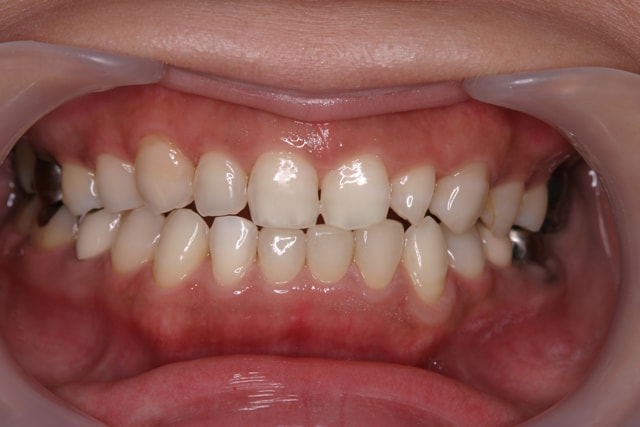 下の前歯3本をラミネートベニアで修復した症例治療後
