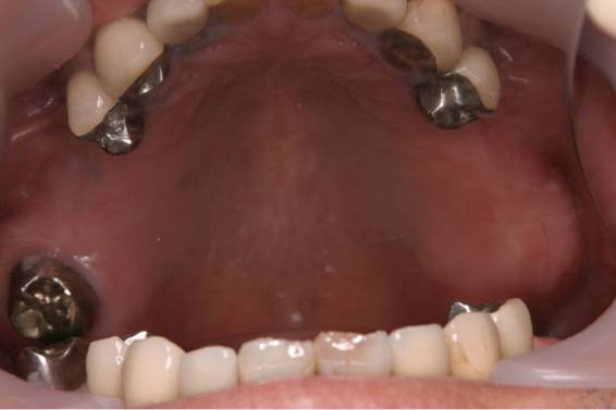 入れ歯をインプラントでやり変えた症例1治療前