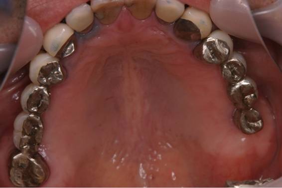 入れ歯をインプラントでやり変えた症例治療後