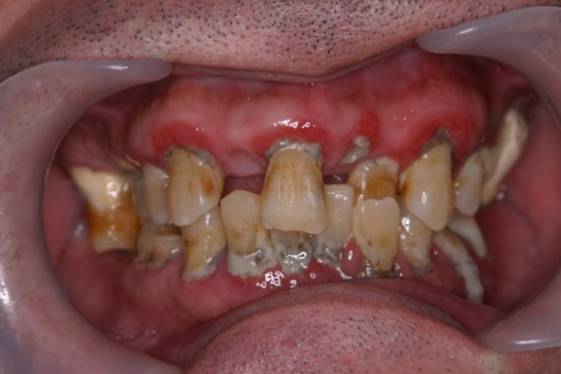 長期間放置された口腔内を全体的に治療した症例1治療前