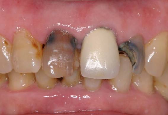 長期間放置された虫歯をポーセレンクラウンで治療した症例治療前