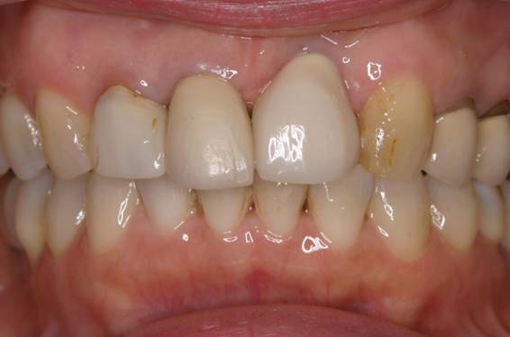歯の大きさのバランスを、ポーセレンクラウンで改善した症例治療前