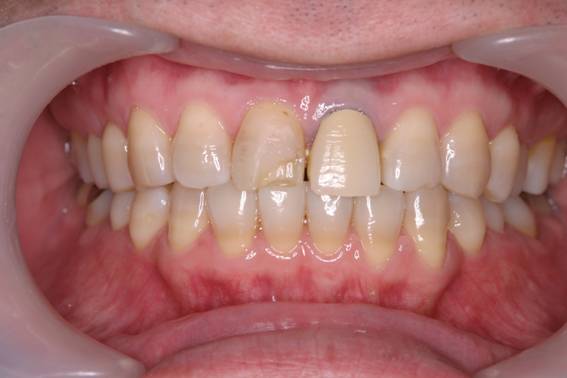 前歯の破折をコンポジットレジンで修復した症例治療前