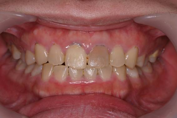 変色歯をポーセレンクラウンで改善した症例治療前