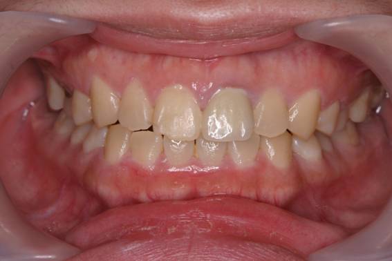 変色歯をポーセレンクラウンで改善した症例治療後