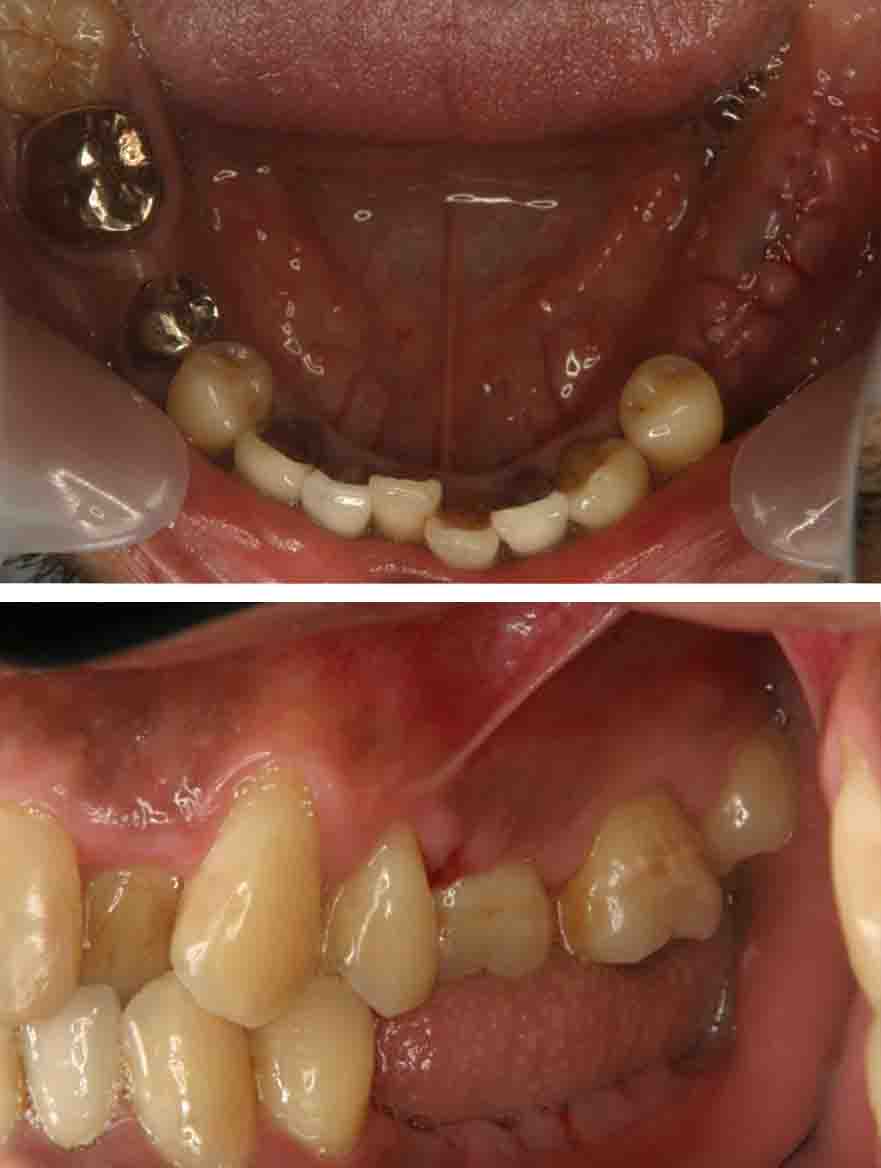 左下の欠損部にインプラントを入れた症例治療前