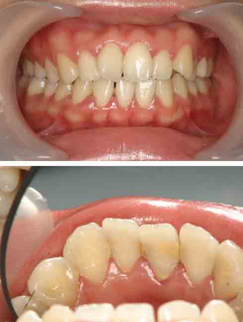 歯周病治療2治療前