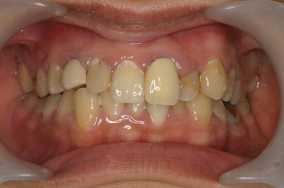 歯周病治療１治療前