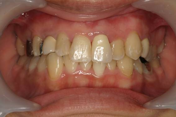 歯周病治療１治療後