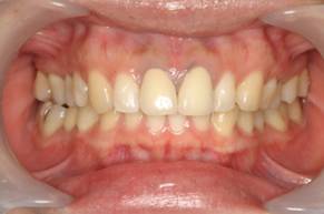 金属イオンの漏出による歯茎の黒ずみを改善した症例治療前