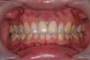 金属イオンの漏出による歯茎の黒ずみを改善した症例治療後