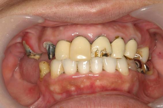 長期間放置された口腔内を全体的に治療した症例2治療前