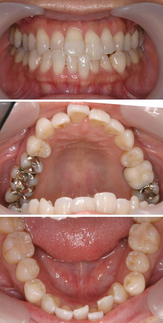 ＭＴＭで上下前歯の歯並びを治療した症例2治療前