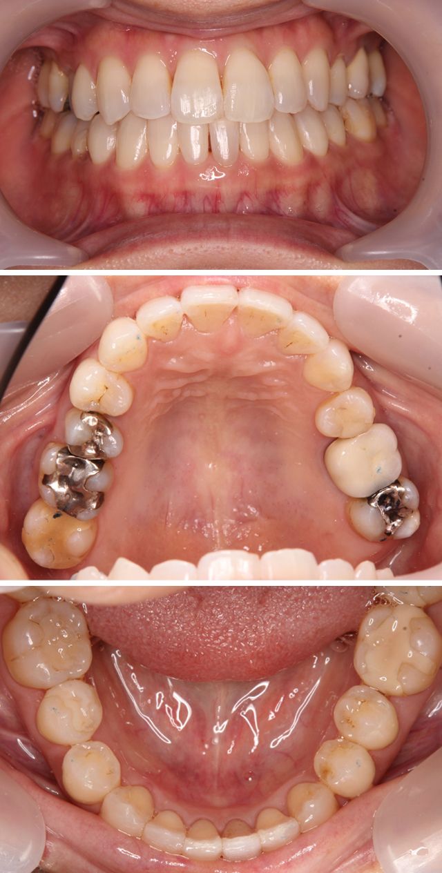 ＭＴＭで上下前歯の歯並びを治療した症例2治療後