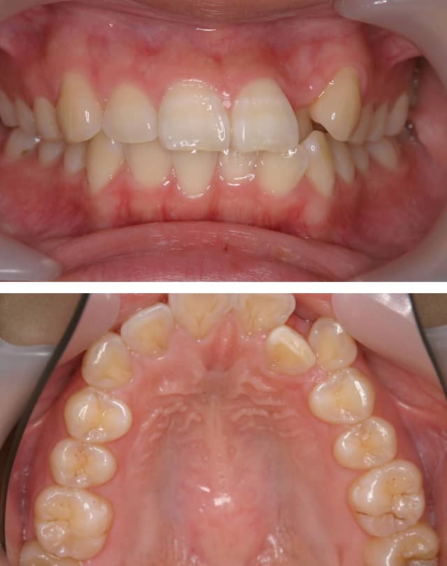 ＭＴＭで内側に引っ込んだ歯を治療した症例治療前