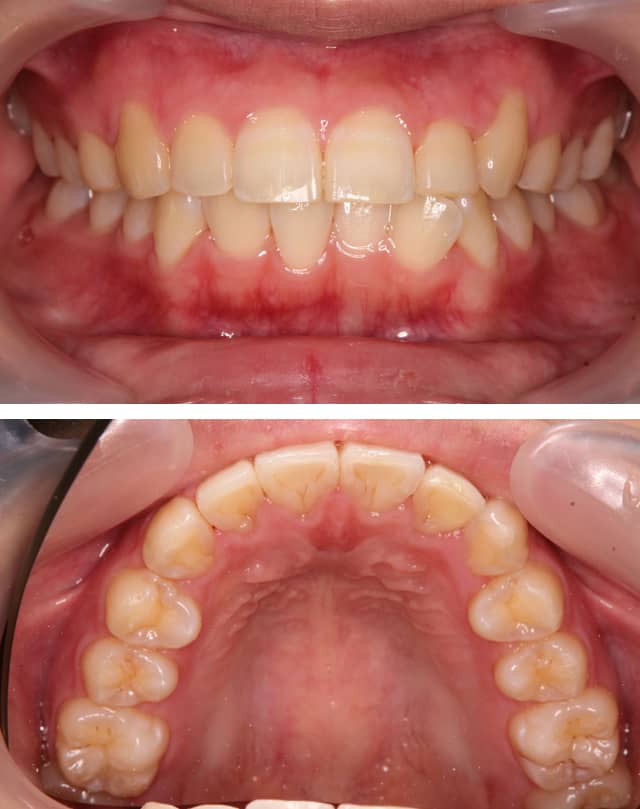 ＭＴＭで内側に引っ込んだ歯を治療した症例治療後