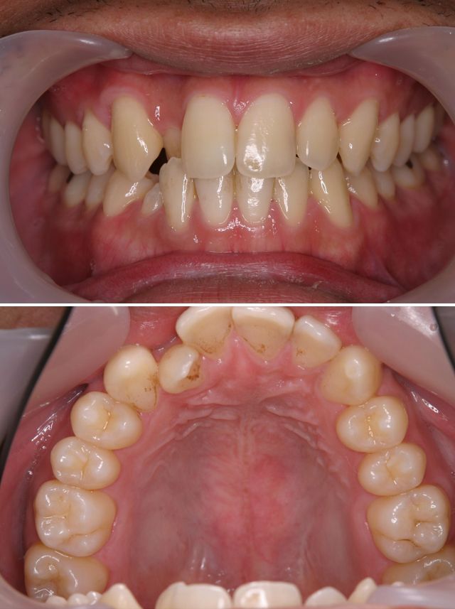 ＭＴＭで右の前歯を前に出した症例治療前