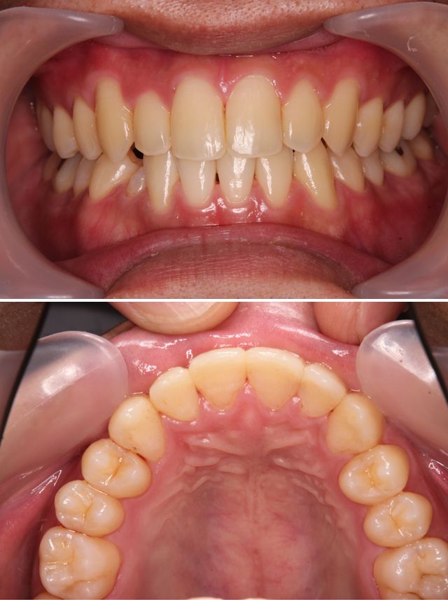 ＭＴＭで右の前歯を前に出した症例治療後