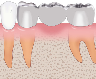 歯のブリッジ治療の構造