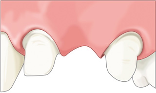 ブリッジ治療では前後の歯を削る