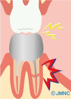 強く噛んで歯根が折れている