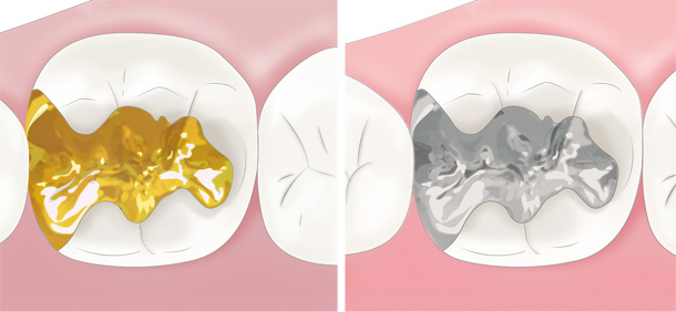 ゴールドと金銀パラジウム合金のインレー