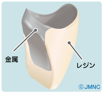 硬質レジン前装冠