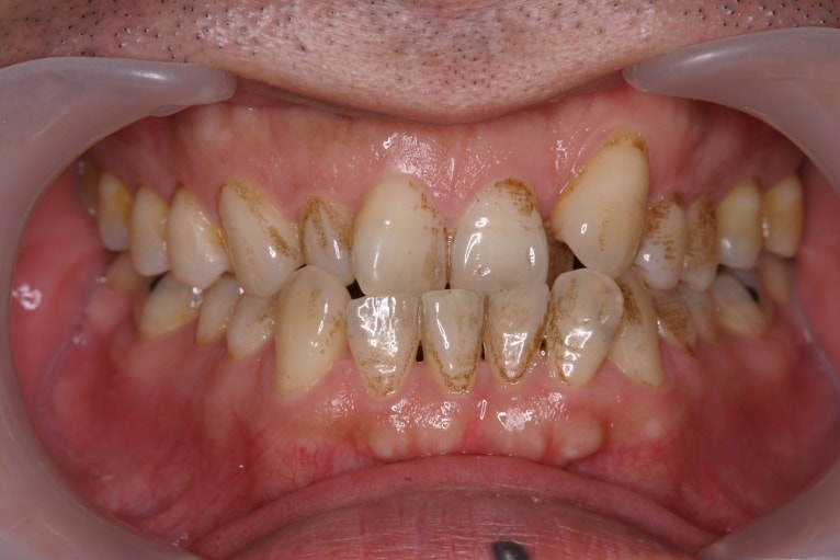 汚れを取り除くにはどうすればよいですか?