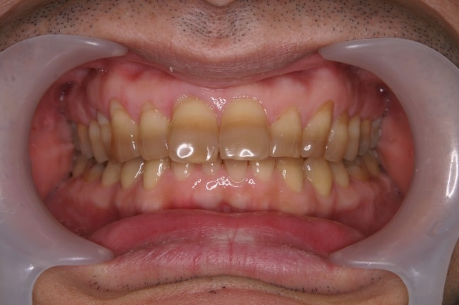 薬剤の影響で歯が全体的に縞状に変色