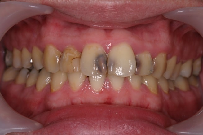 虫歯の部分は黒くなります