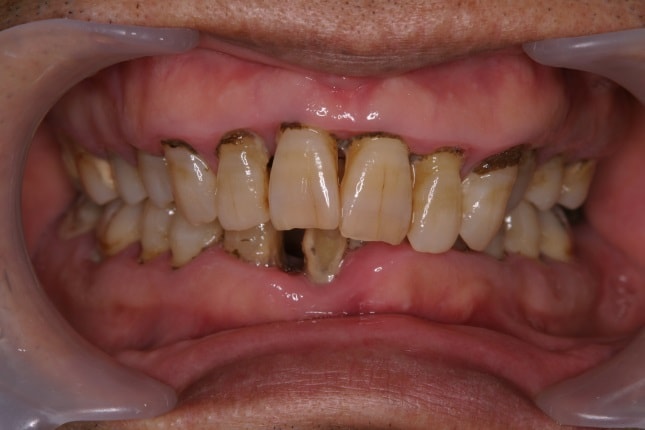 歯の根元に黒い歯石が沈着