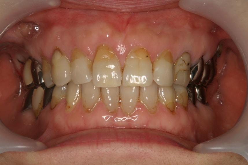 以前詰めた歯の根元のコンポジットレジンが変色）