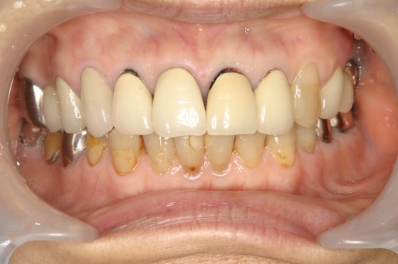 歯肉が下がったことによる歯根の露出（向かって正面右側と左側2番目の歯と歯肉の境目）