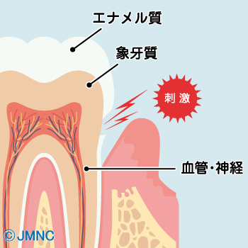 知覚過敏の構造