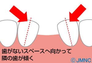 抜けた前後の歯が倒れていく