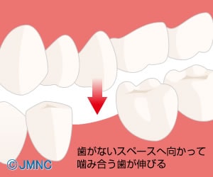 抜けた上下の歯が伸びる